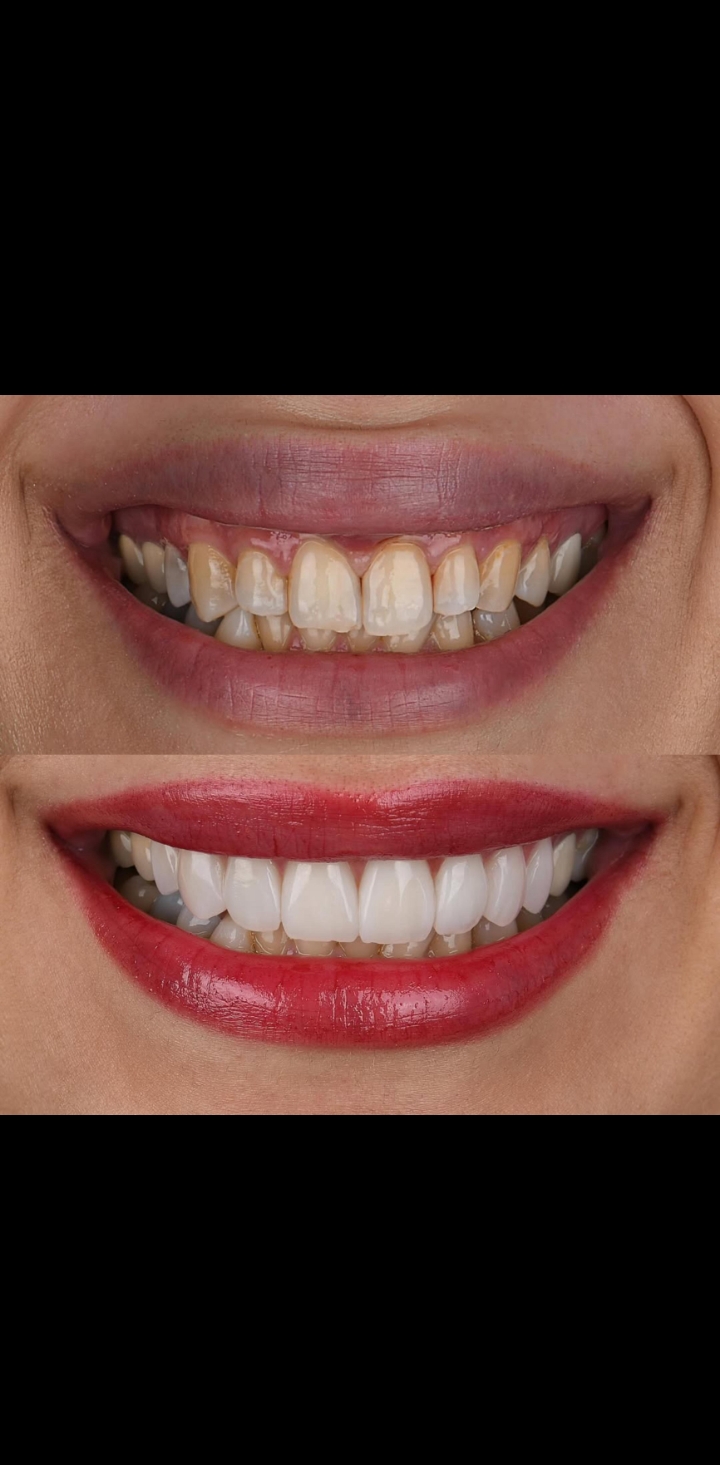 Bone Grafting Background