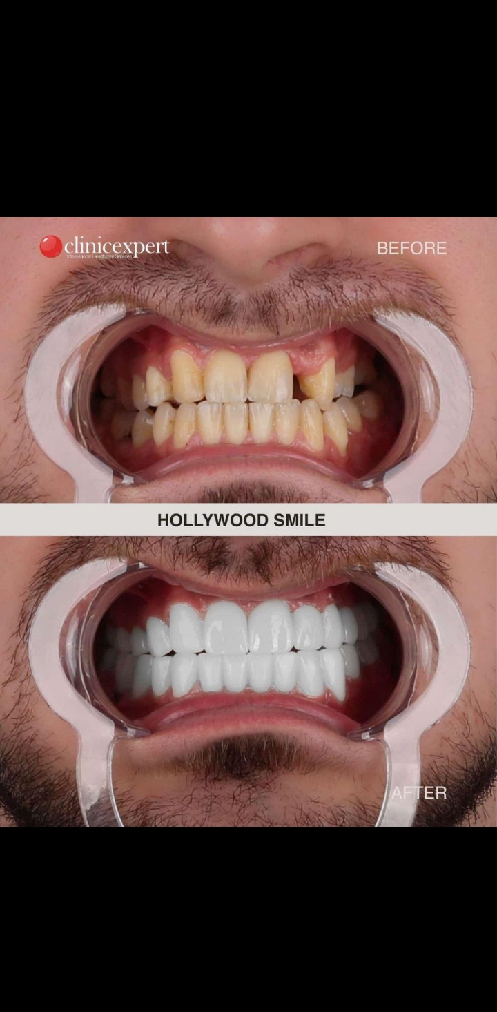 After treatment with LUMIRA