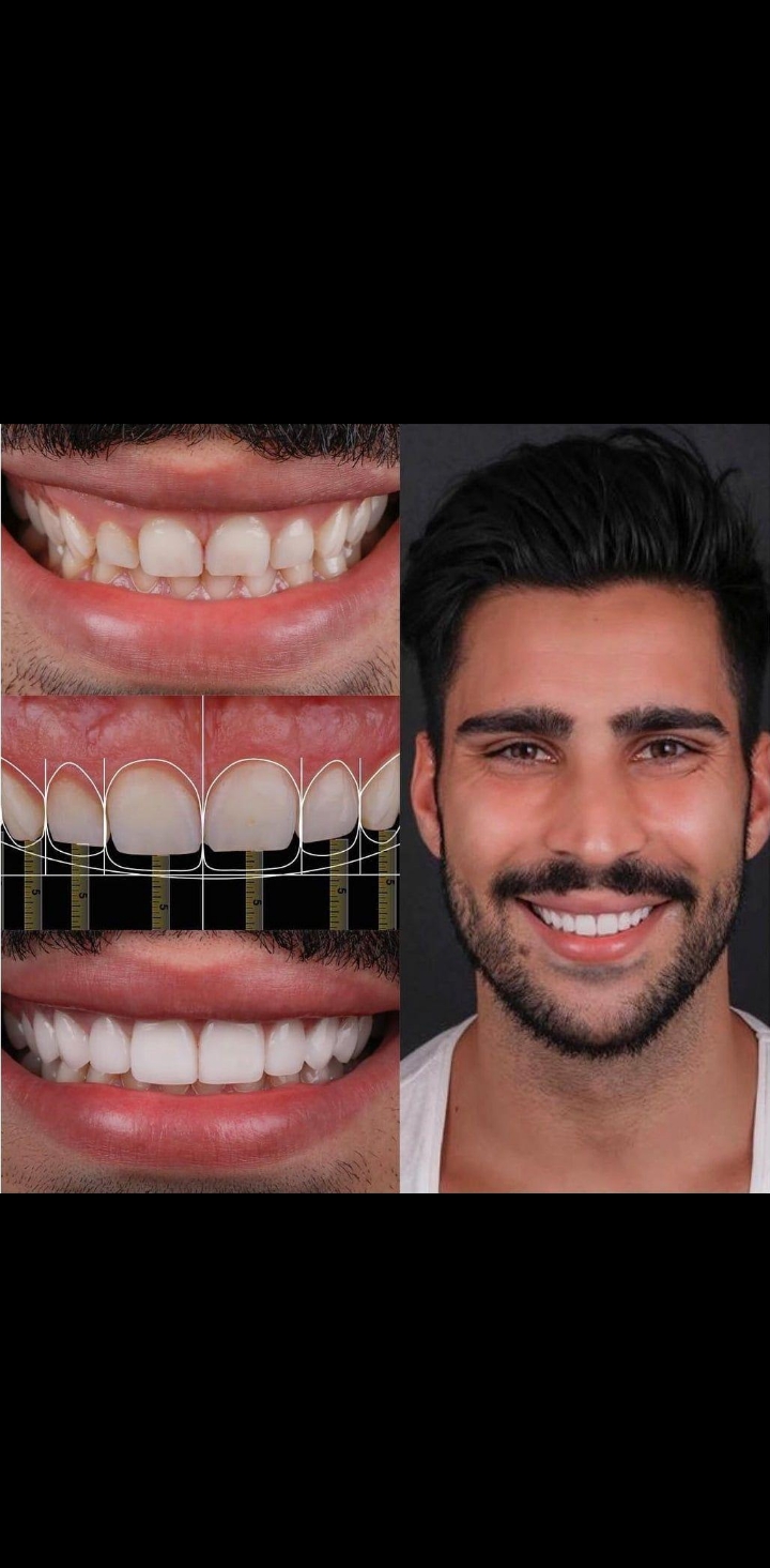 أدوات تنظيف وحشو العصب الدوّارة (Rotary Endodontics)