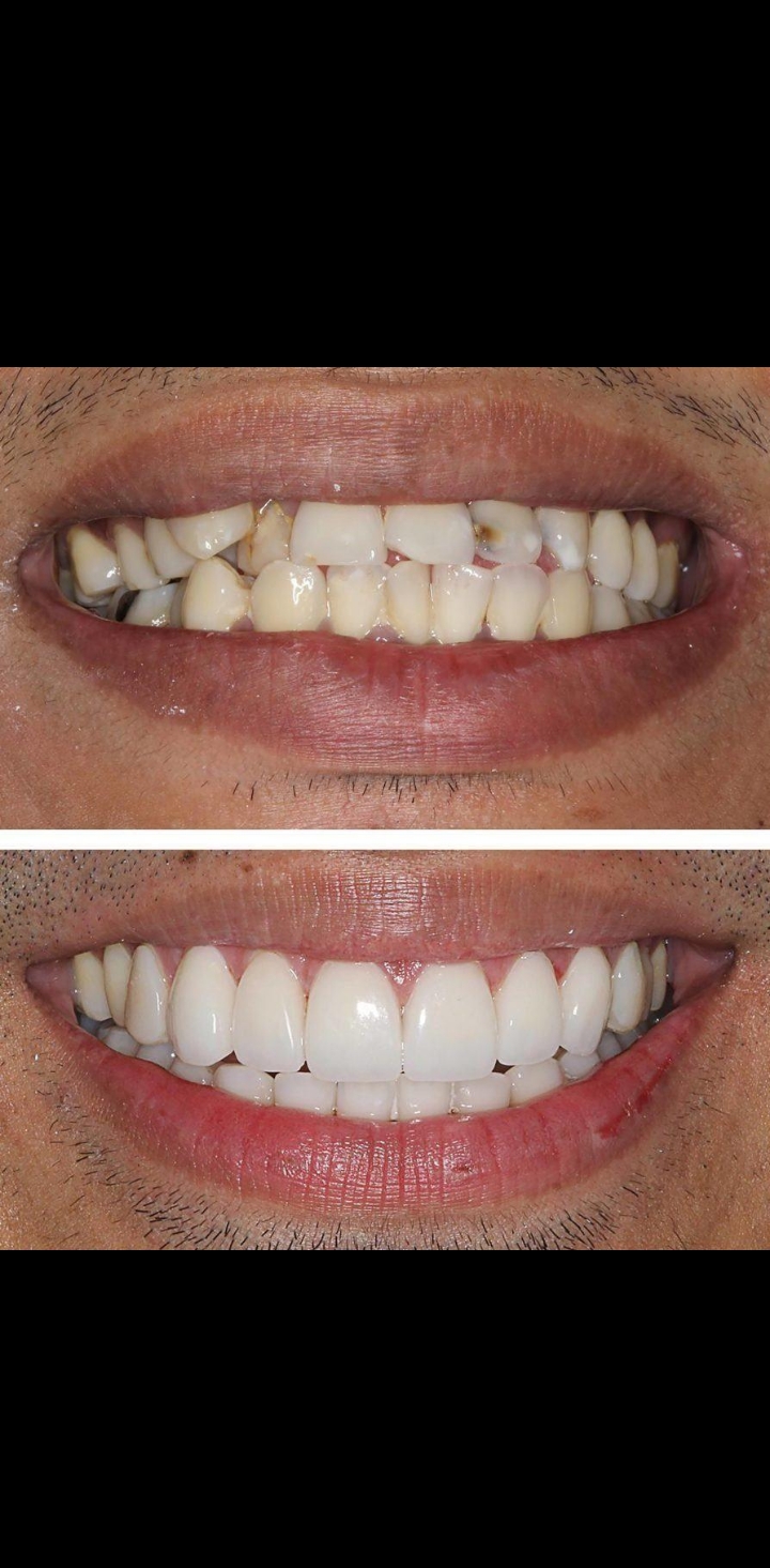 ORIVÉ clear aligners