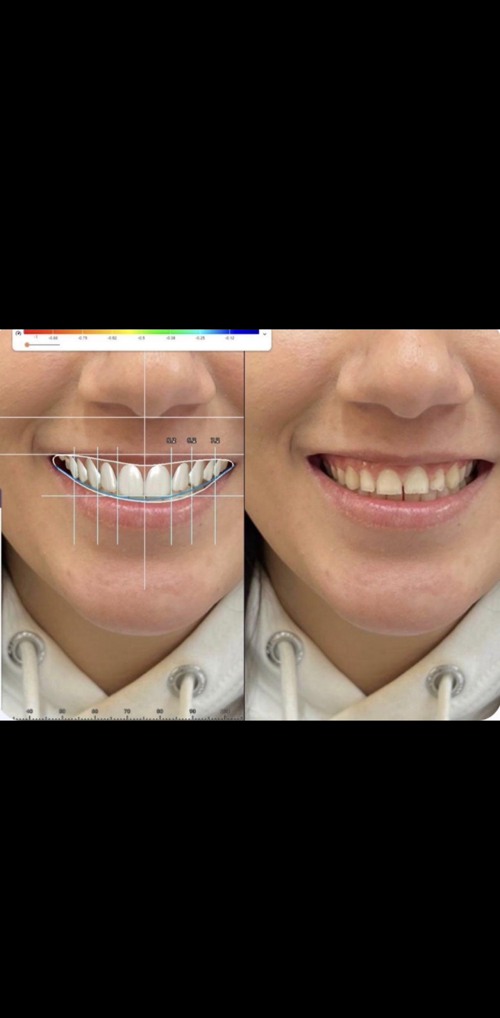 LUMIRA smile design